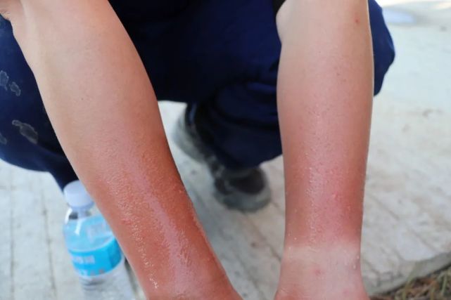 转播中球员晒伤,场上紧急换人! 转播中球员晒伤,场上紧急换人!